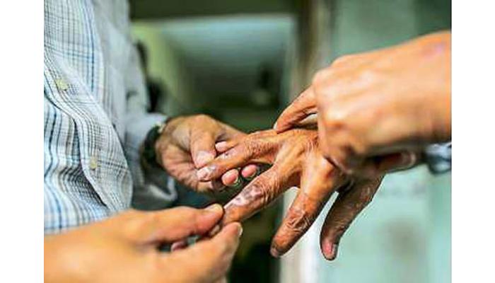 कुष्ठरुग्ण शोध मोहिमेमध्ये सातारा जिल्हा राज्यात दुसऱ्या क्रमांकावर
