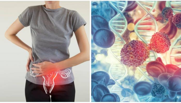 महिलांसाठी ओव्हरियन कॅन्सर सायलंट किलर