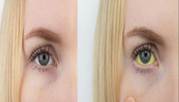 कावीळ झाल्यावर सपोर्टीव ट्रीटमेंट