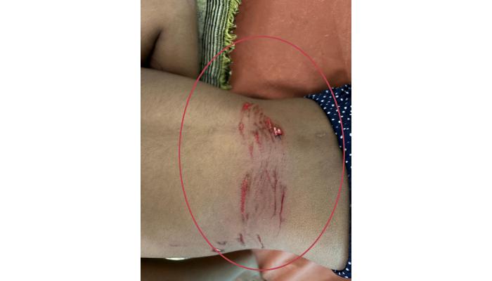 जकातवाडीत भटक्या कुत्र्याच्या हल्ल्यात ११ जण जखमी, जखमींमध्ये दोन लहान मुलींचा समावेश, काहींना गंभीर दुखापती