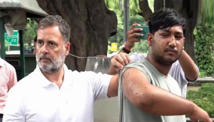 आमच्या विद्यार्थ्यांना मारहाण करणे, धमकावणे बंद करा करा - राहुल गांधी ठाम, पोलीस हल्ल्यातील जखमी आंदोलकाला सर्वांसमोर आणले
